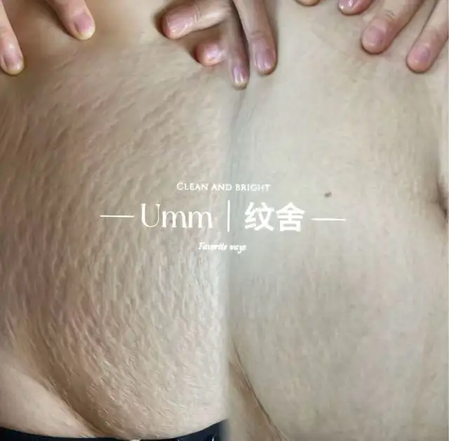广州产后妊娠纹路修复｜宝妈群主合作，预付+30%高分成，零售后-1
