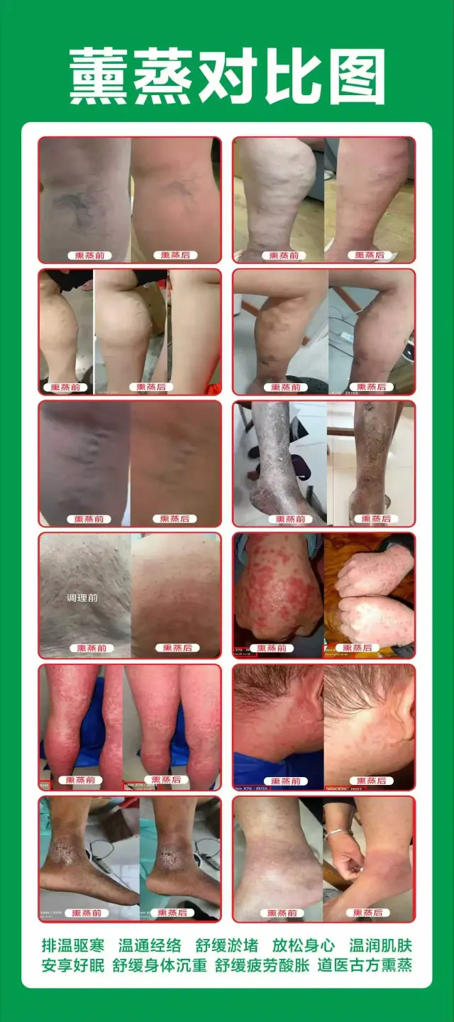 道家秘方古法熏蒸透骨熏蒸-1